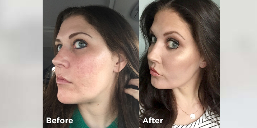 I Nixed My Acne Scars for Good with Fractional CO2 Laser
