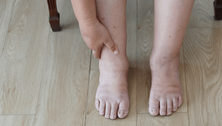 swollen feet