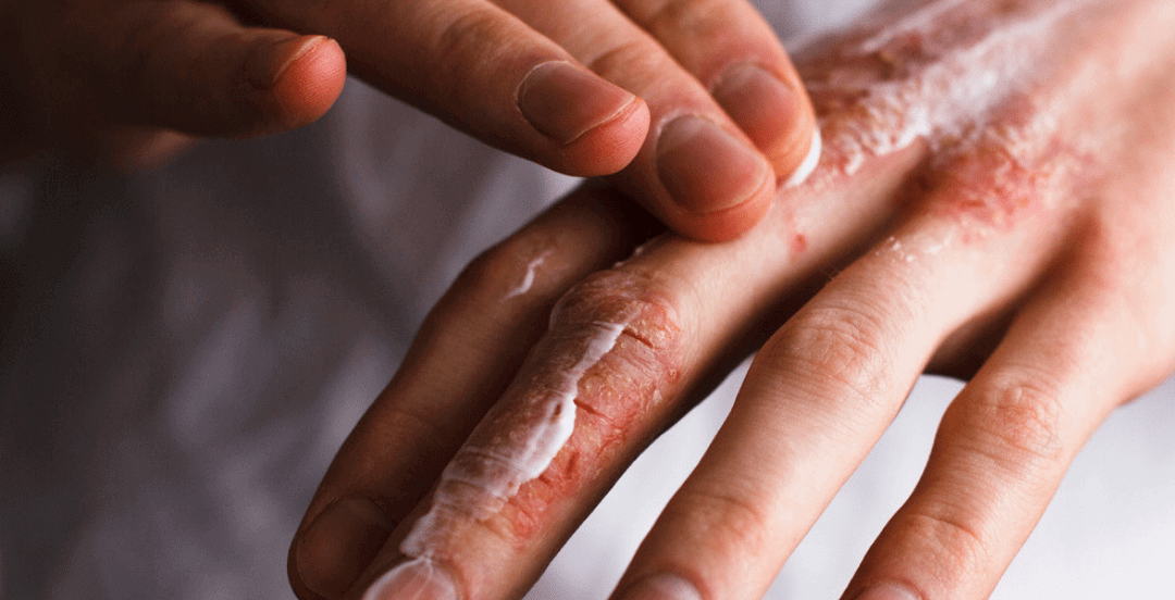 Applying lotion on hands with infection