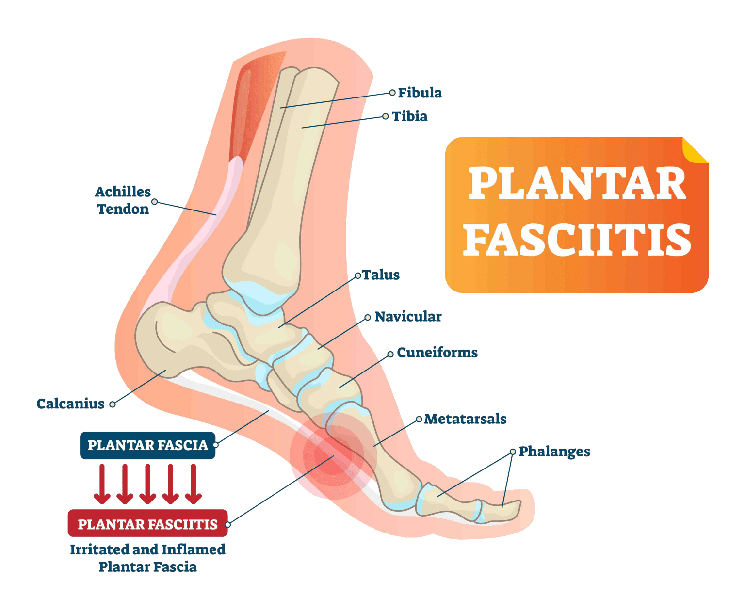 Foot Or Heel Pain It Might Be Plantar Fasciitis Healthy You