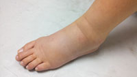 Lymphedema foot